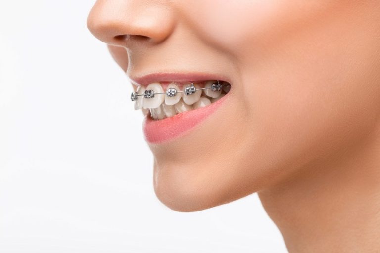 Are Overbites Bad? Tips On Braces & Orthodontics