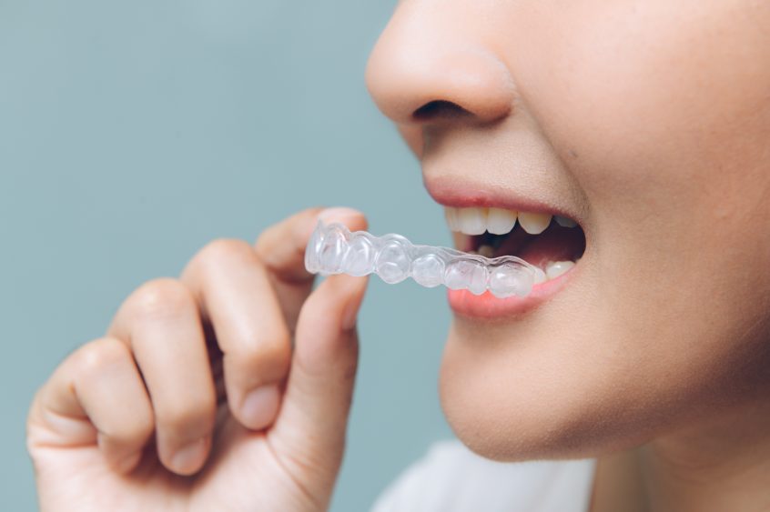 women putting Invisalign into her mouth
